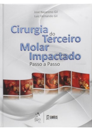 CIRURGIA DO TERCEIRO MOLAR IMPACTADO - PASSO A PASSO