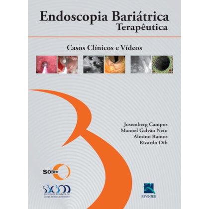 SOBED ENDOSCOPIA BARIÁTRICA TERAPÊUTICA